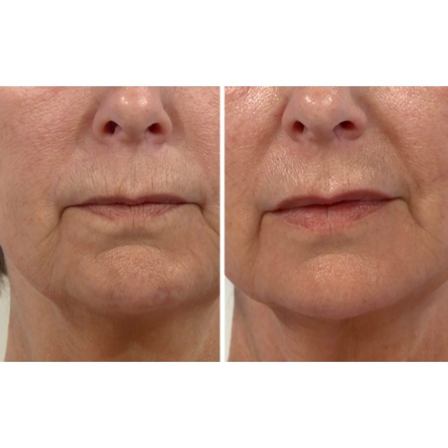 Image 111578_ALTMORE8.jpg, Product 111-578 / Price $180.00, Lab Life Beauty Lip Plumper from Lab Life Beauty on TSC.ca's Beauty department